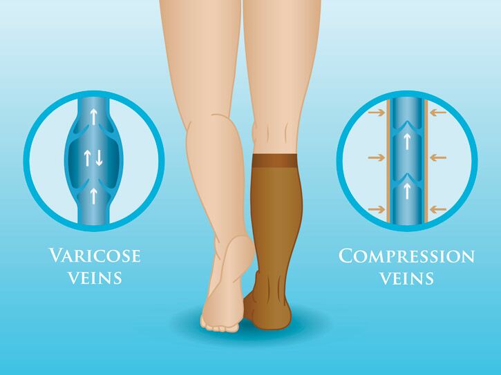 The Many Uses for Compression Socks